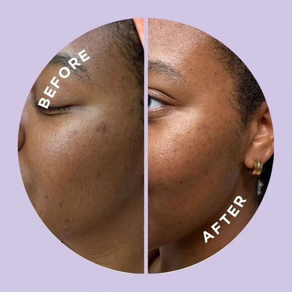 HYPERFADE by ZitSticka, Microdart Patch to Fade Post-Zit Dark Spots - 12 Count - Picture 8 of 8